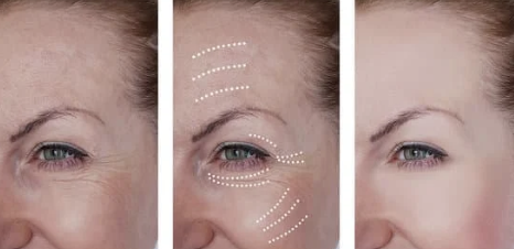 눈가 주름과 다크서클 개선 (생활습관 + 과학적 근거) 설명사진