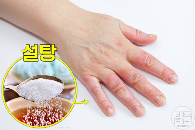습진에 좋은음식 안좋은음식 설탕