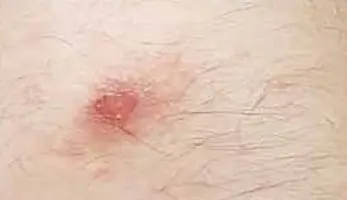 SFTS 중증열성혈소판감소증후군 증상 4가지