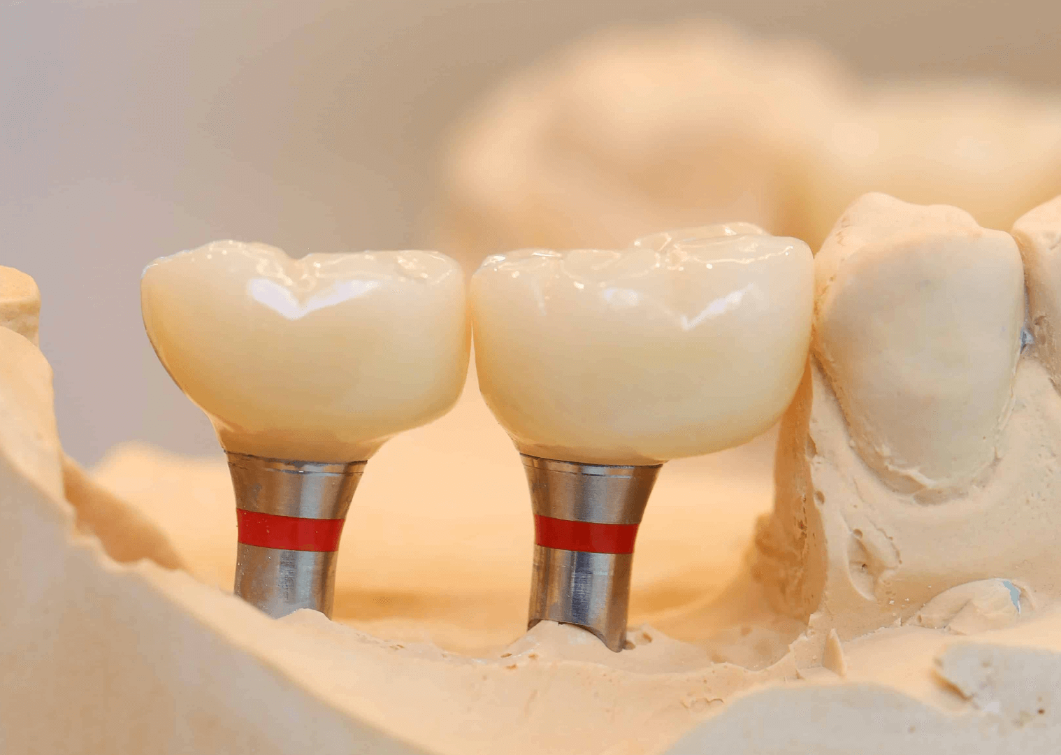 지르코니아 크라운