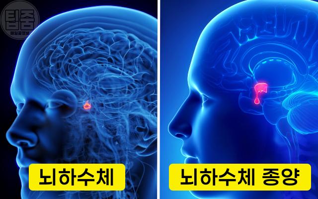 뇌종양 증상 호르몬 불임