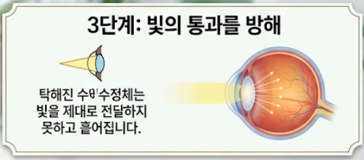 백내장 증상