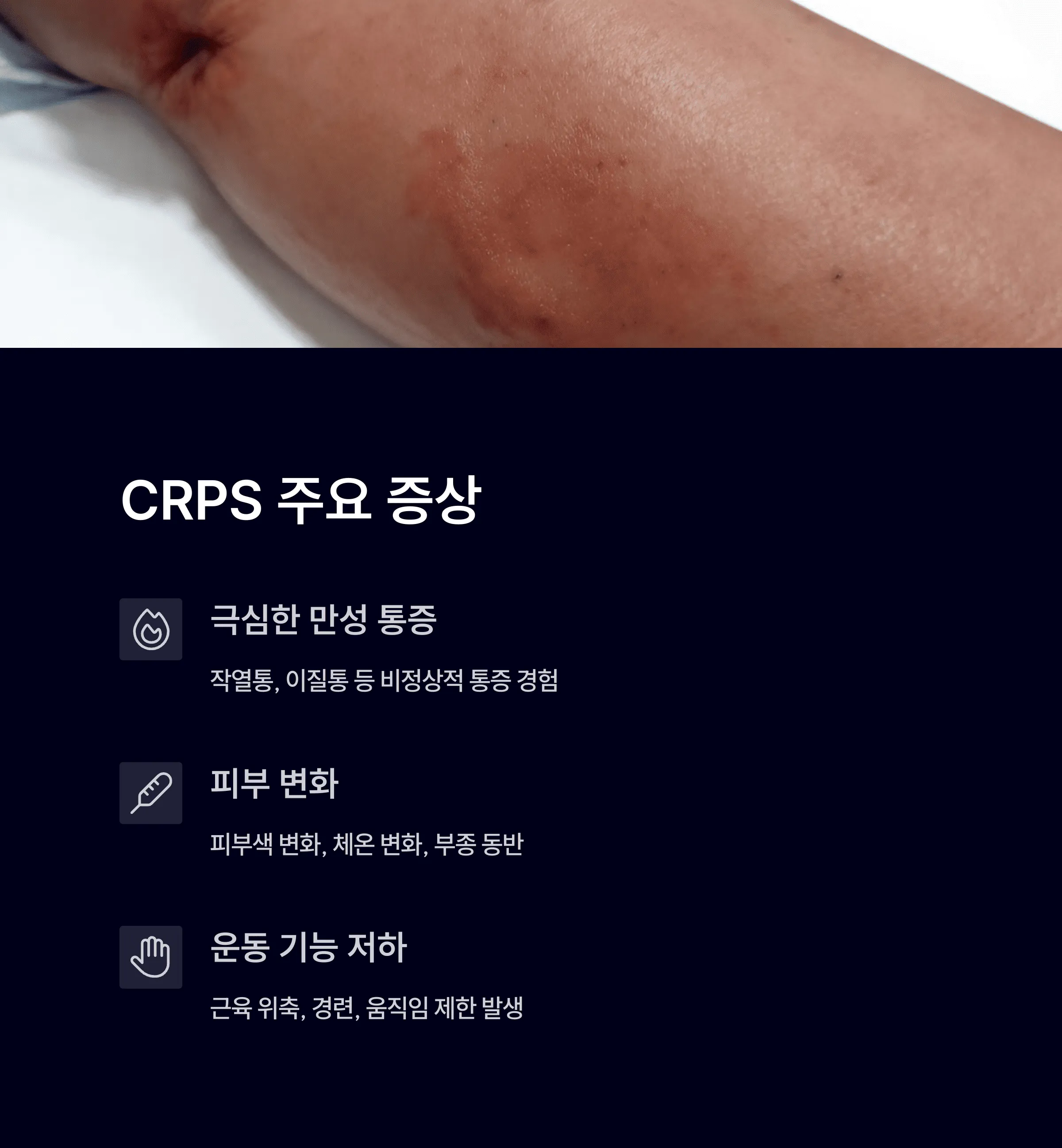 복합통증증후군이 뭔가요? 주요 증상과 치료 가이드