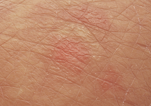 노인성 피부 가려움증 해결 방법