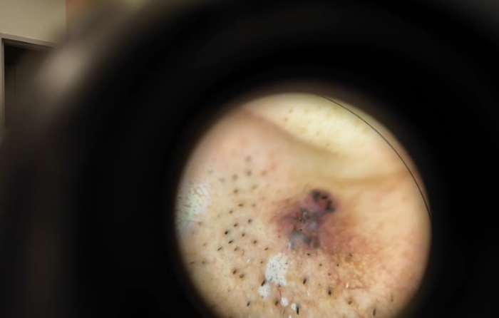 명의 피부암 점 구별법