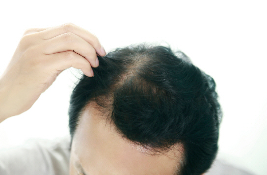 탈모 원인과 탈모 샴푸 효과 없는 이유