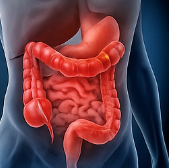 대장암 초기증상