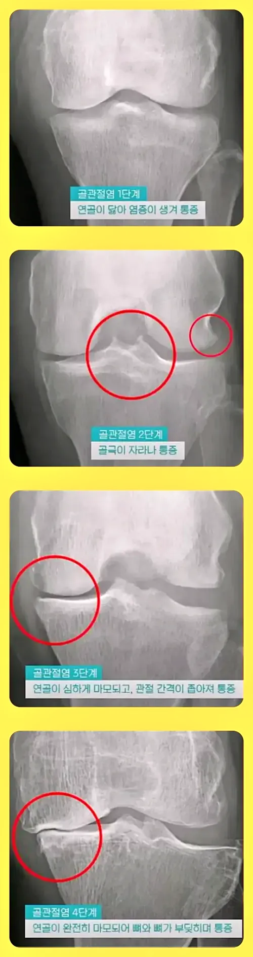 무릎 퇴행성관절염의 1~4기별 모습
