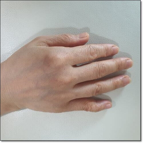 척골충돌증후군 원인 및 증상과 치료 관리