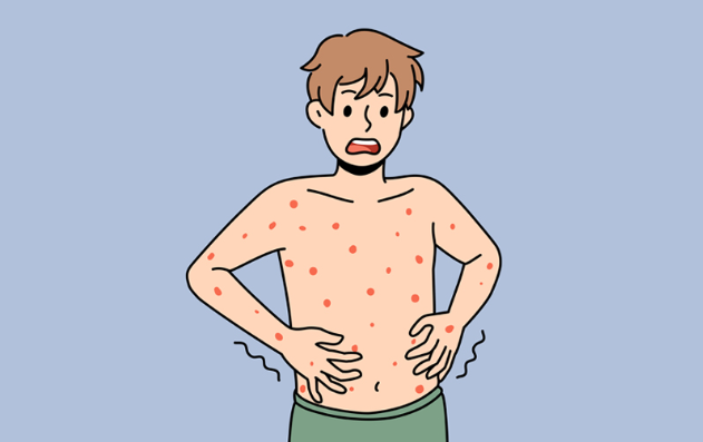 홍역 증상 완벽 가이드