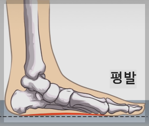 족저근막염발바닥 통증