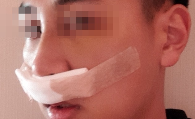 비중격 만곡증 수술 후기