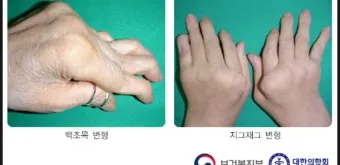 효과적인 류마티스 관절염 치료제 추천 약물 비교 가이드 2025 최신판_3