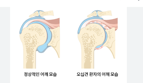 50대 관절 통증&amp;#44; 원인과 대처법