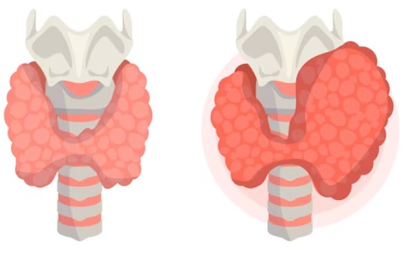 비인두암을 가리키고 있는 그림입니다.