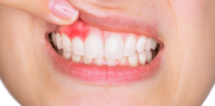 잇몸 피나는 원인