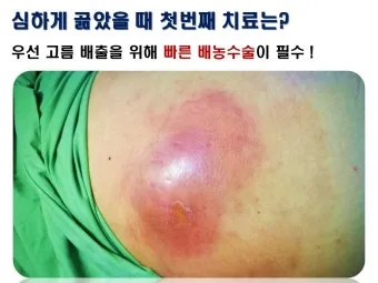 엉덩이 종기가 생기는 이유 왜 생기고 어떻게 관리할까요 완벽 가이드_24