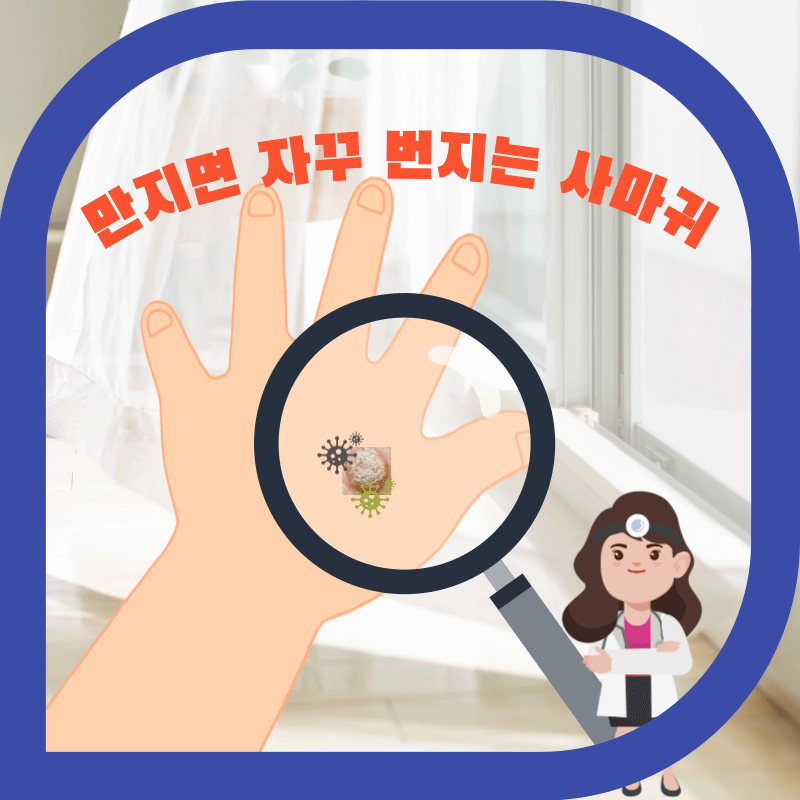 사마귀가 난 손등의 이미지