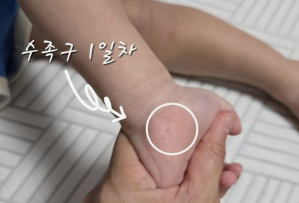 수족구 수포 - 작은 물집 하나에 무너진 엄마의 하루