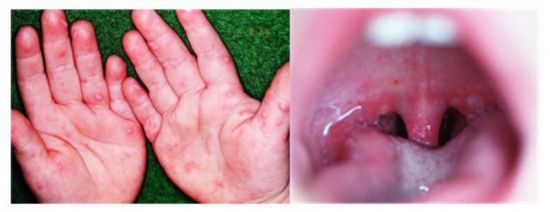 수족구병 증상 원인 치료 전염 수포 잠복기