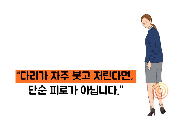 하지 정맥류 증상