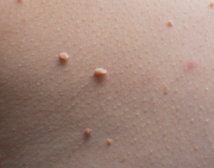 쥐젖 발생원인 진단방법 치료 관리방법