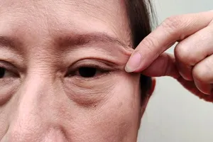 눈밑 지방재배치 수술