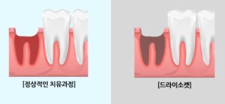 건성 소켓 치료법과 회복 기간