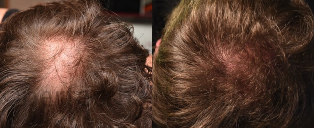 확산형 탈모 사진