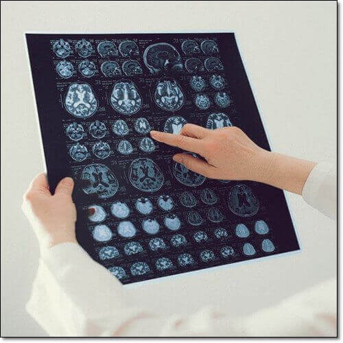 프테로스틸벤 두뇌 건강 효과