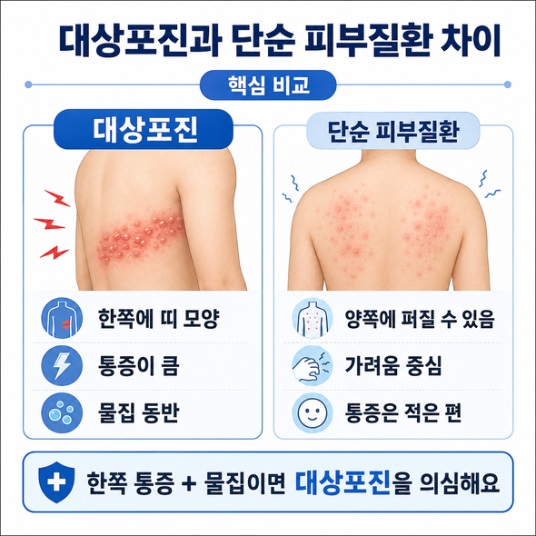 대상포진 초기증상