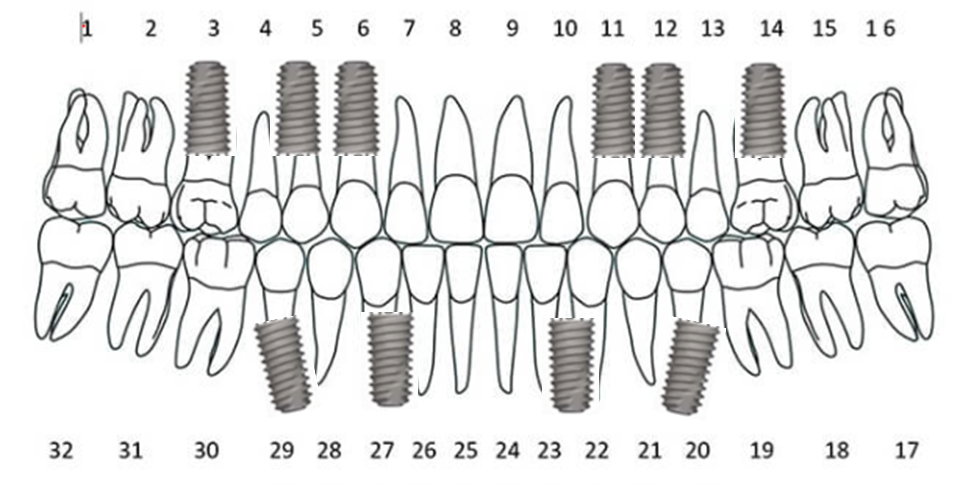 전체임플란트개수3