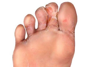 발무좀 종류 및 발무좀 없애는 방법 (feat. 무좀 연고 추천)