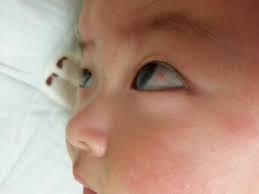 눈 실핏줄이 터지는 이유