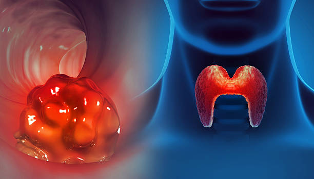 갑상선 기능 항진증의 치료방법을 설명하는 이미지