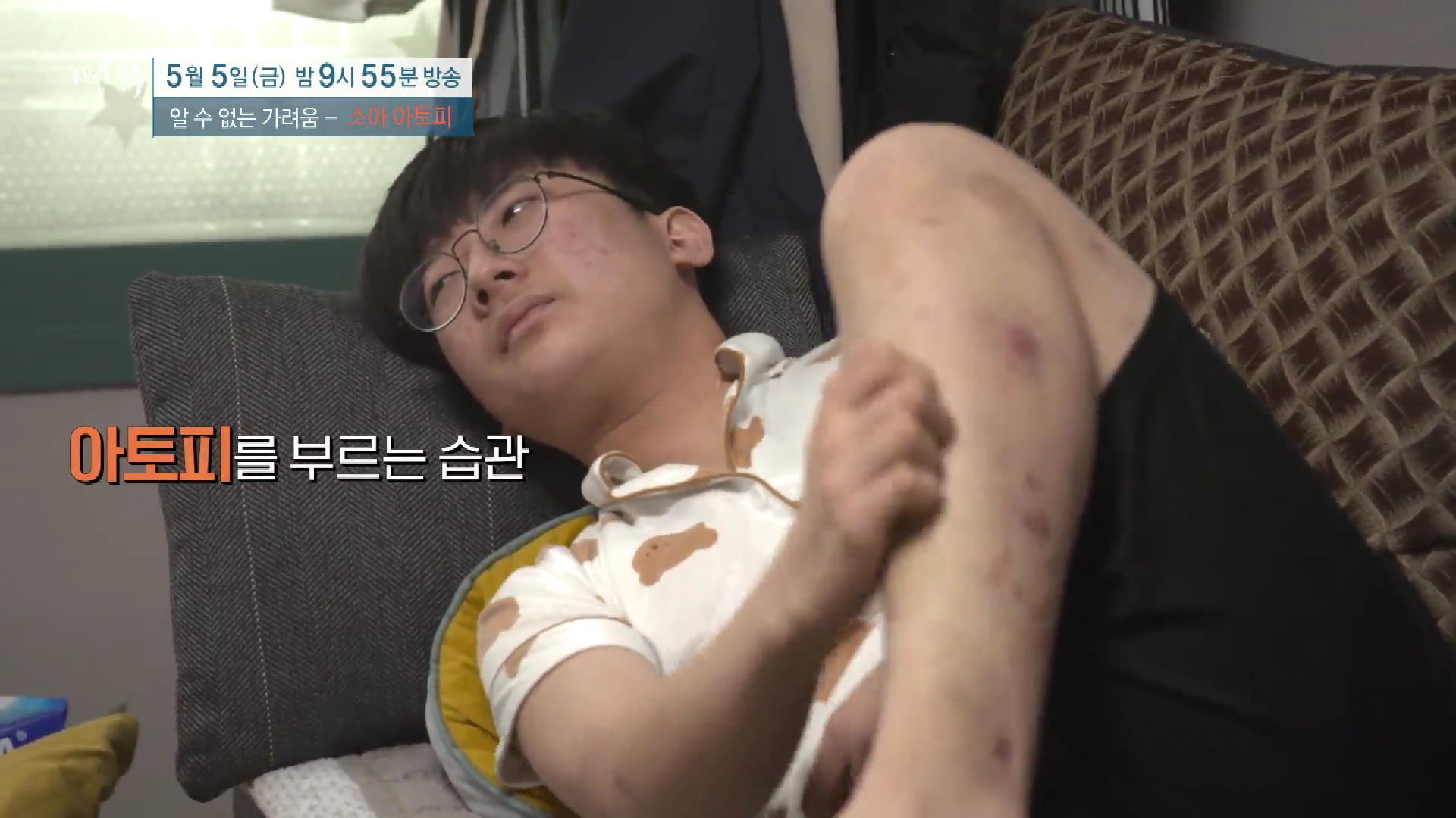 명의 어린이 소아 아토피 피부염 스테로이드 효과 및 부작용 완치 치료제 신약 비용 방법