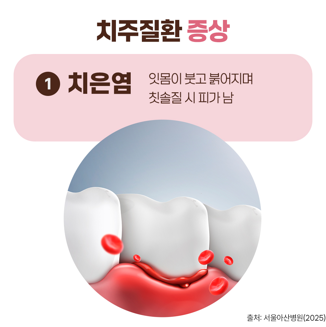 #치주질환 증상 #치은염 #잇몸이 붓고 붉어지며 칫솔질 시 피가 남