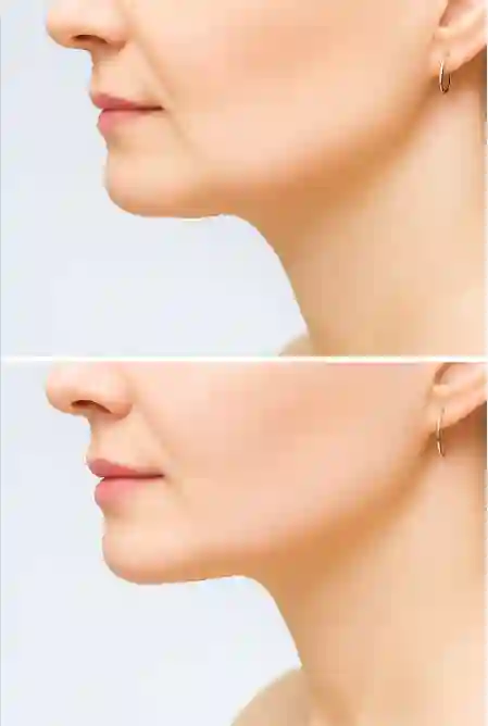 팔자 주름 없애는 얼굴 운동 5분 루틴