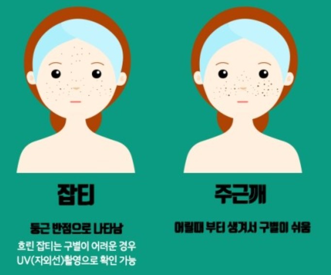 잡티와 주근깨의 차이