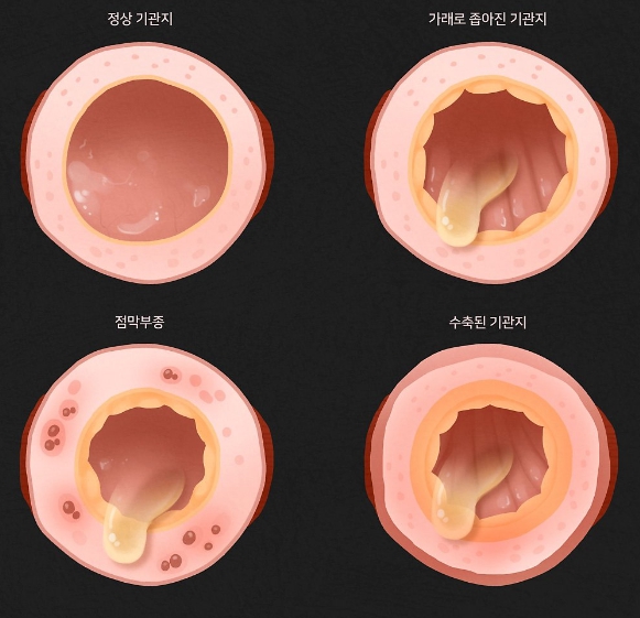 천식에 의한 기관지 상태