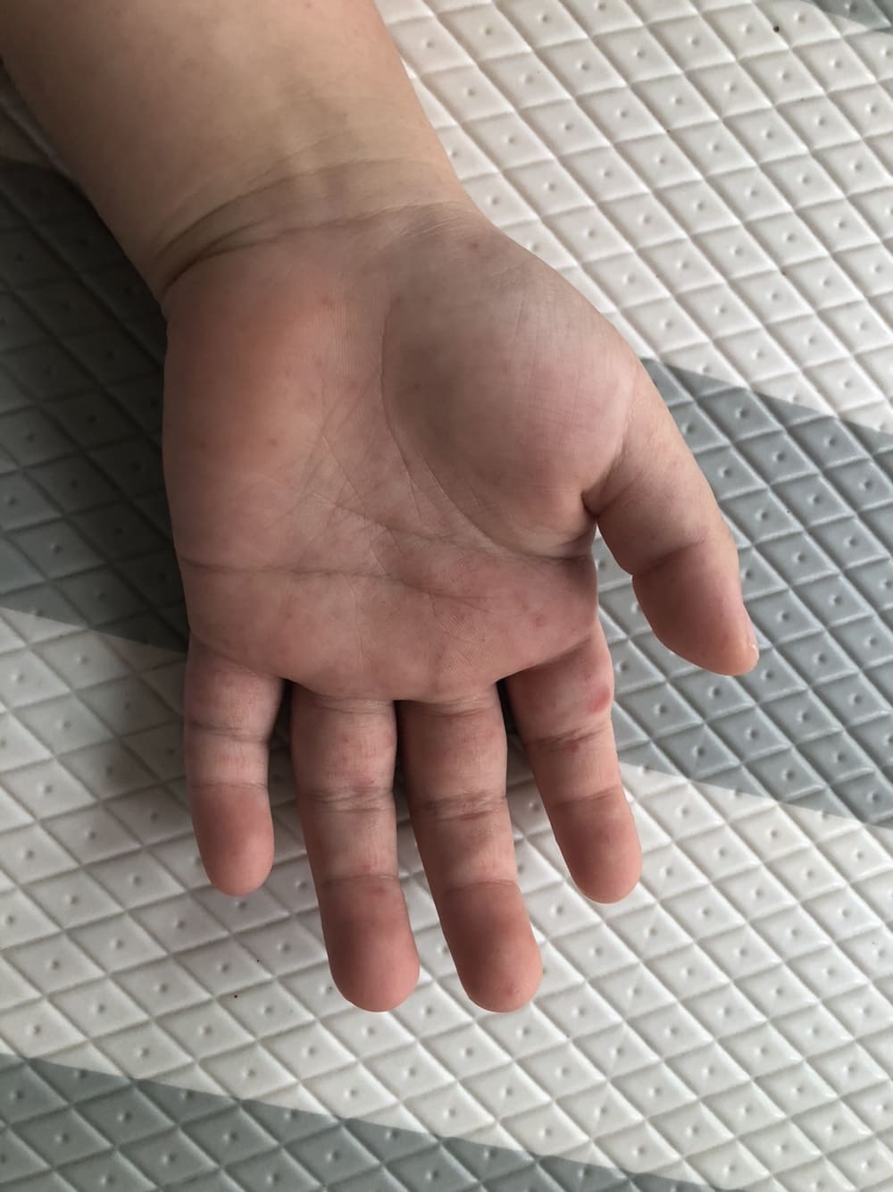 첫째아이 왼손붉은발진