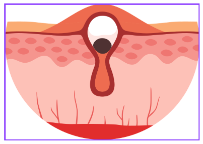 모낭염 원인과 치료방법