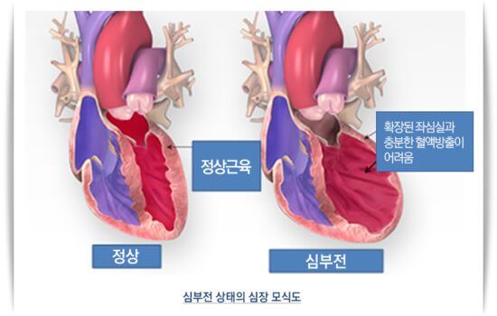 심부전 증상