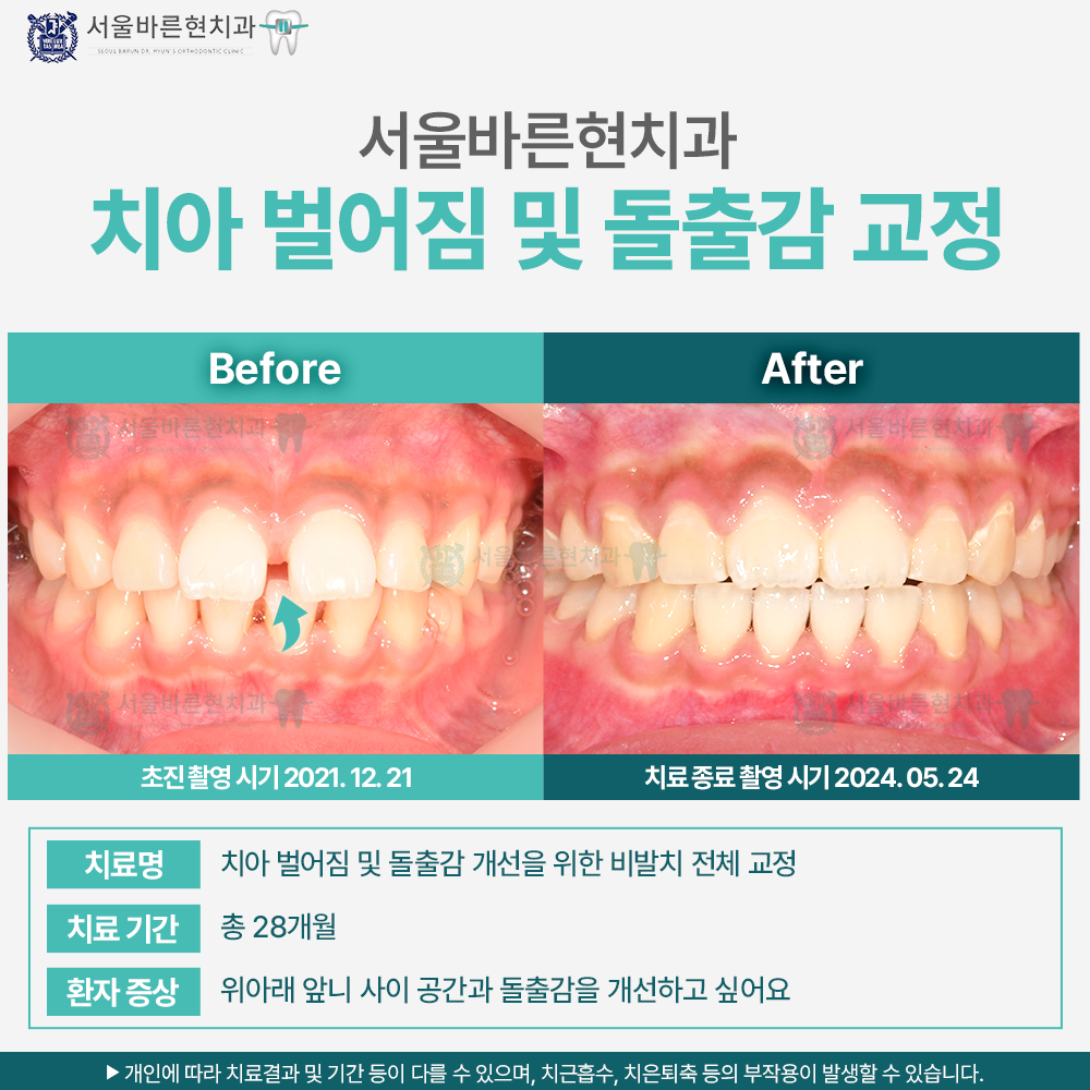 부산치아교정