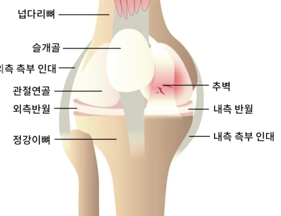 추벽증후군 무릎 수술 치료법 및 자연치유 방법들