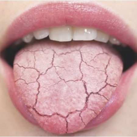 혀끝이-갈라지는-증상