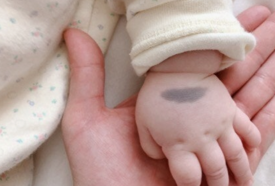 아기 얼굴 몽고반점, 걱정되시죠?