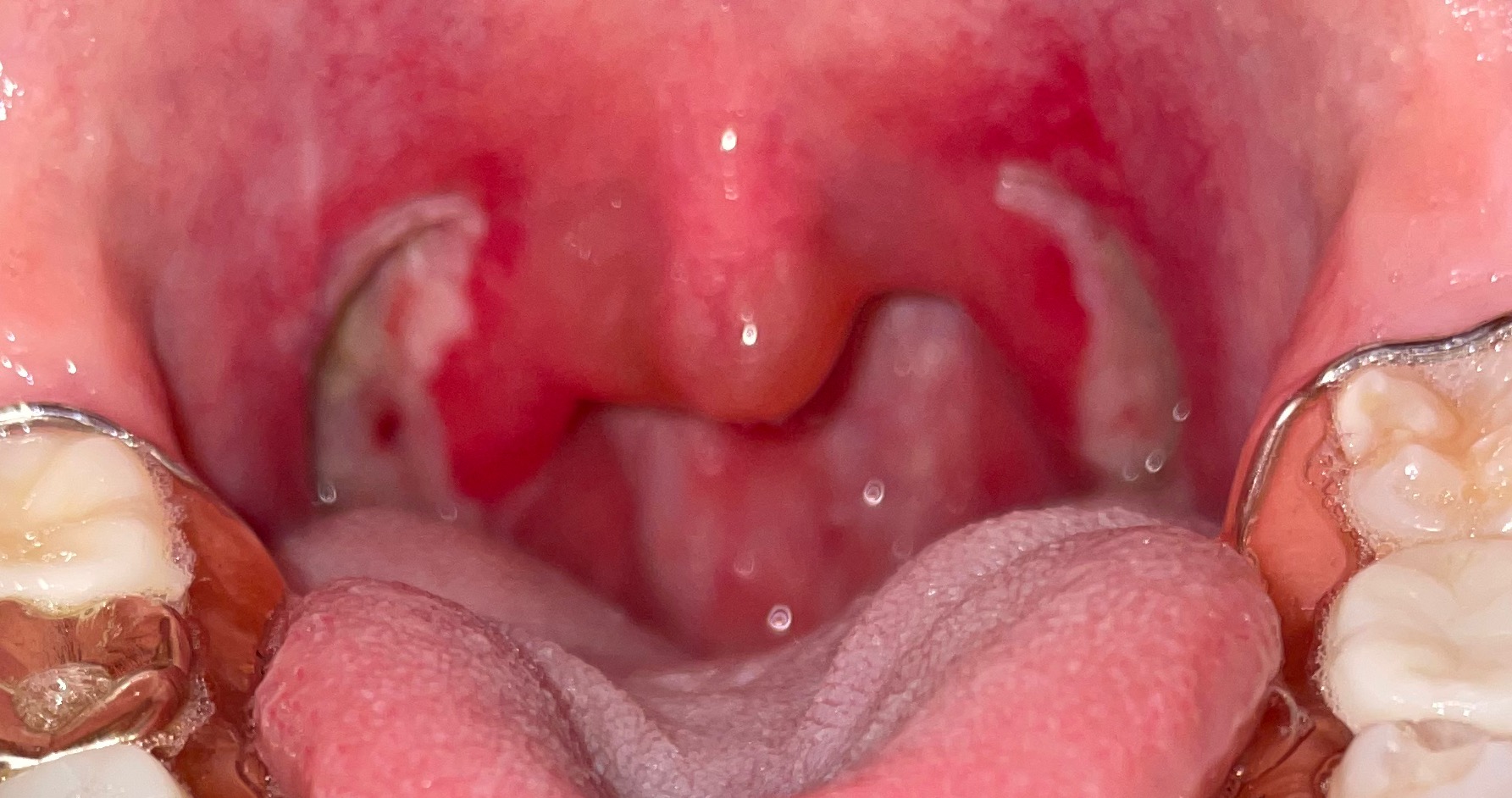 편도 절제 수술 1일차