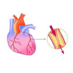 협심증 치료 방법