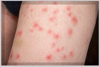 빈대 물리면 증상&amp;#44; 자국